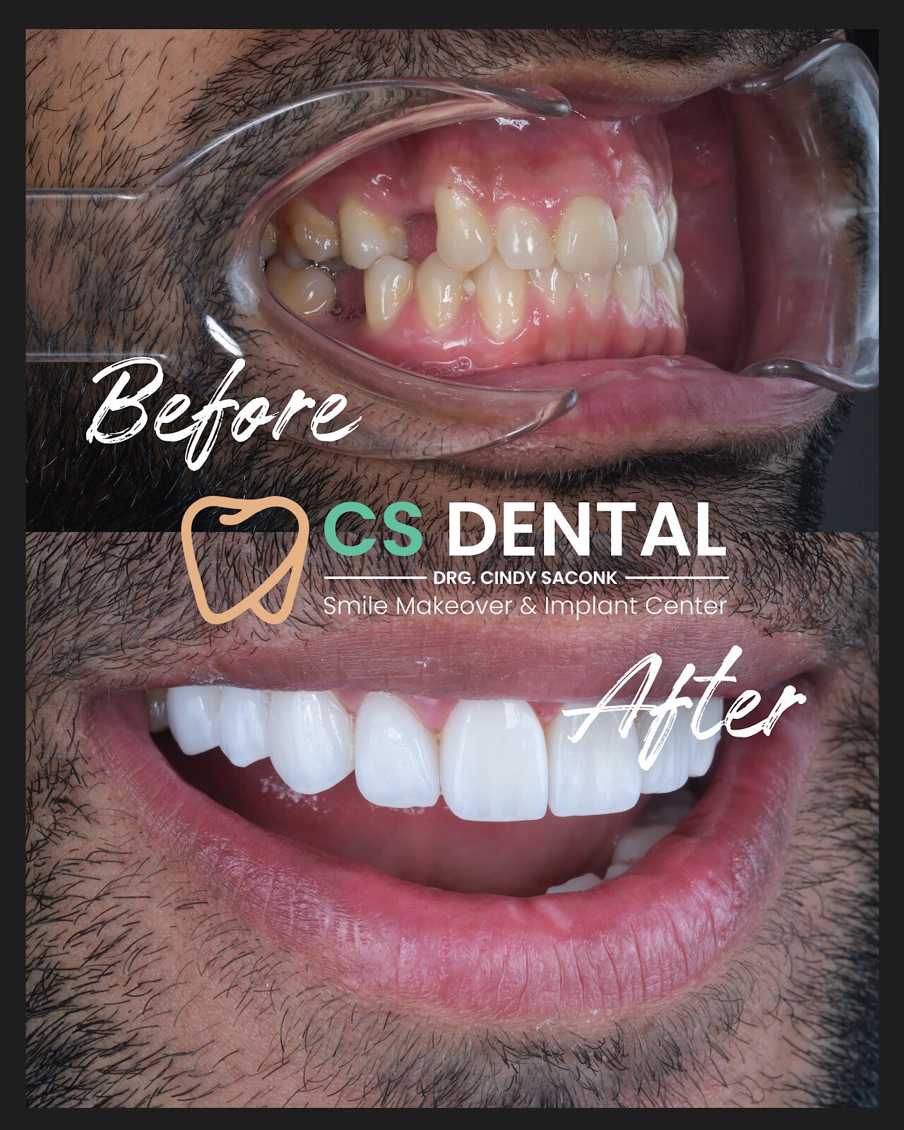 Klinik Gigi Canggu Bali - CS Dental Canggu Aesthetic Clinic & Dental Lab Bali
